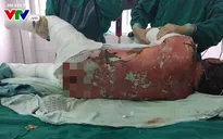 Cảnh báo tổn thương da nghiêm trọng do dị ứng thuốc