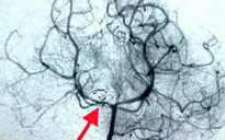 Một bé gái 3 tuổi bị vỡ phình mạch não