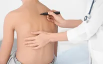 Phòng bệnh cong vẹo cột sống cho trẻ