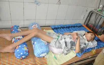 Nhiễm trùng uốn ván, tính mạng cậu bé học lớp 6 nguy kịch