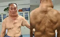 Cổ phình to bất thường vì nghiện rượu 26 năm