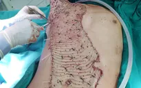 Kinh hãi: Liên tiếp các nạn nhân bị máy bóc gỗ lột da ở Phú Thọ