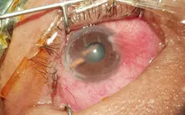 Đi rừng chặt cây mây, người đàn ông bị gai đâm thủng mắt