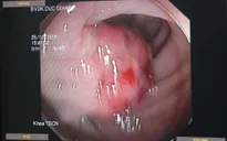 Cắt polyp đại tràng kích thước 2,5 cm