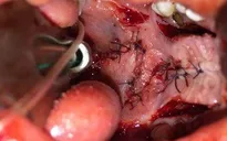 Chăm sóc trẻ sau mổ khe hở vòm miệng