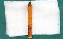 Bạn trêu đùa, bé trai bị bút chì đâm sâu vào mông