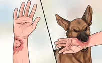 Tử vong vì bệnh dại sau khi bị chó cắn 4 năm trước