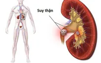 Hiểu đúng về bệnh thận mạn