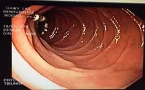 Gắp dị vật trâm gai lấy tủy răng trong tá tràng bệnh nhân