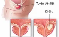 Tại sao nam giới cần tầm soát tuyến tiền liệt?