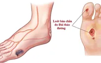 Biến chứng thần kinh ở bệnh nhân đái tháo đường