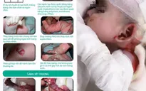 Gian nan hành trình chăm sóc trẻ bị ly thượng bì bóng nước