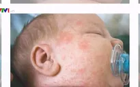 Hơn 85% trẻ mắc sởi nhập viện do chưa được tiêm phòng