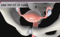 Mỗi ngày, Việt Nam có 7 ca tử vong vì ung thư cổ tử cung
