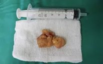 Cắt bỏ khối u cho hai bệnh nhân bị u mũi xoang và u dây thanh