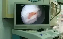 Nội soi thực quản gắp xương heo cho bệnh nhân