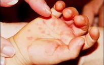 Hà Nội cảnh báo dịch tay chân miệng xuất hiện tại 28 quận huyện