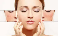 Thận trọng với phương pháp lăn kim làm đẹp da