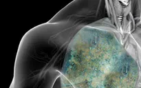 Thừa Thiên Huế: Gia tăng số ca mắc bệnh lao mới, nguy cơ lây nhiễm lao tiềm ẩn