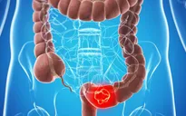Tránh ung thư đại tràng bắt đầu bằng việc điều chỉnh thói quen