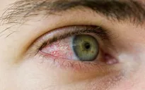 Những điều cần lưu ý với bệnh nhân viêm kết mạc dị ứng