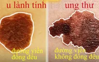 Bạn có biết cách nhận biết nốt ruồi ung thư?