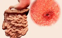 Bất ngờ biến chứng nguy hiểm từ trào ngược dạ dày thực quản