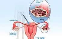 Điều trị hội chứng u đa nang buồng trứng