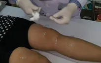 Cấy chỉ điều trị bệnh gút