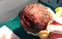 Mẹ chồng dùng dao rạch tầng sinh môn đỡ đẻ, thai nhi bị rách đầu