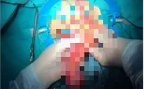 Phẫu thuật nội soi cắt toàn bộ mạc treo trực tràng qua đường hậu môn