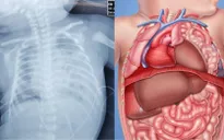 Hơn 10 trẻ sơ sinh thoát vị hoành bẩm sinh được phẫu thuật nội soi thành công