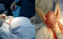 Hà Tĩnh: Phẫu thuật 2 khối u nang buồng trứng “khủng”