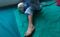 Nguy hiểm: một ca sinh tại nhà, trẻ bị cụt chân vì hội chứng hiếm gặp