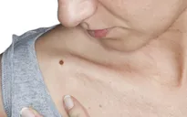 Ngừa ung thư da bằng những cách nào?