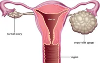 Nguyên nhân và triệu chứng bệnh ung thư buồng trứng