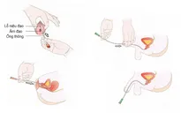 Biến chứng bàng quang thần kinh ở trẻ em