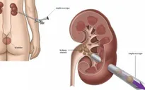 Những ai có nguy cơ mắc sỏi tiết niệu?