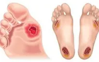 Cách phát hiện biến chứng bàn chân ở người mắc đái tháo đường