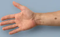 Phát hiện ung thư nhờ máy cảm ứng đo sự phát triển của nốt ruồi