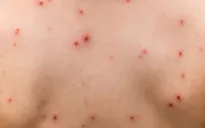 Đắk Lắk: Ghi nhận 2 ổ dịch thủy đậu tại huyện Lắk và TP. Buôn Ma Thuột