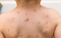 Mắc thủy đậu ngay sau sinh do mẹ bị thủy đậu trước sinh