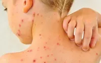 Điều trị thủy đậu an toàn ở trẻ em