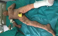 Tổn thương 90% da khi dùng thuốc nam điều trị u phì đại tuyến tiền liệt