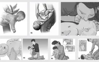 Xử trí và đề phòng hóc dị vật đường thở