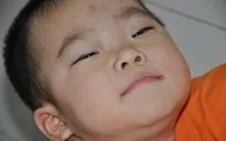 Sặc cháo, bé 3 tuổi bị tổn thương não trầm trọng