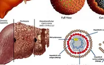 Gần 70% ca ung thư gan có nhiễm virus viêm gan B