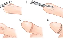 Những quan niệm sai lầm về bao quy đầu