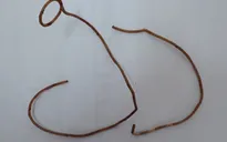 Bệnh nhân có sonde JJ cứng như kim loại