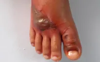 Cấp cứu thành công bệnh nhi bị rắn hổ cắn